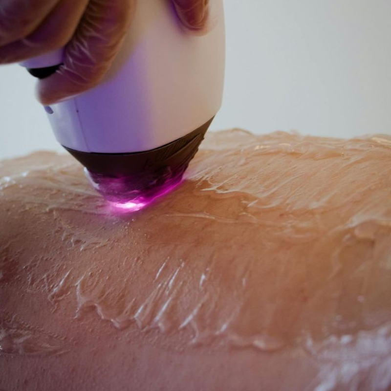 Laser hair removal