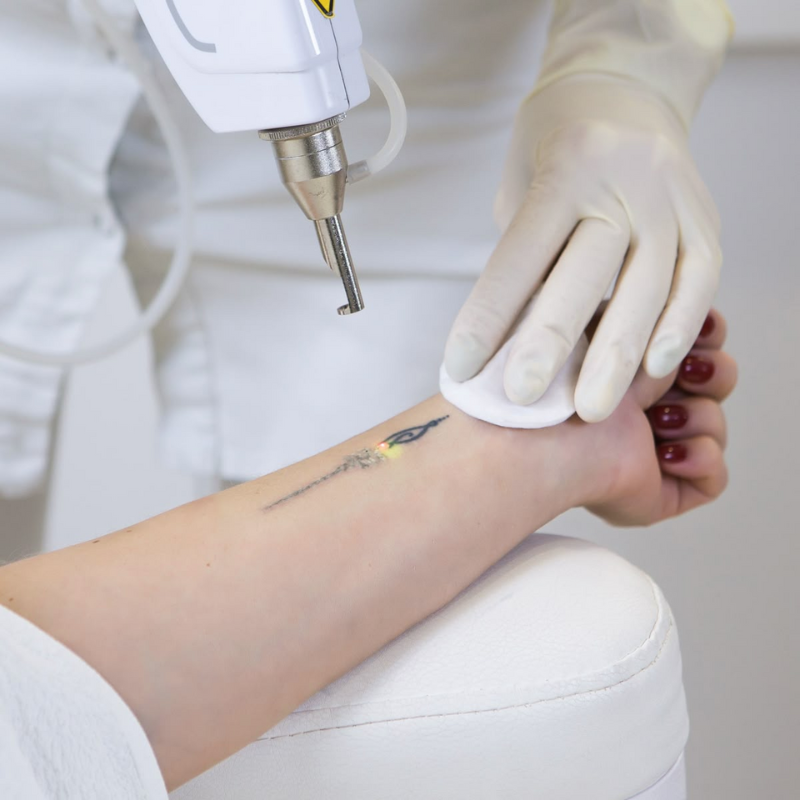 Laser tattoo removal